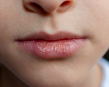 how to get rid of red ring around lips overnight