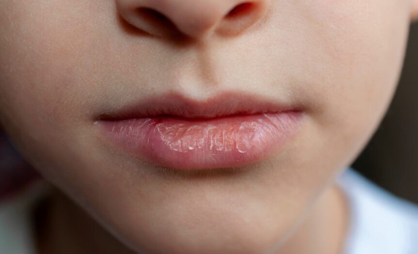 how to get rid of red ring around lips overnight