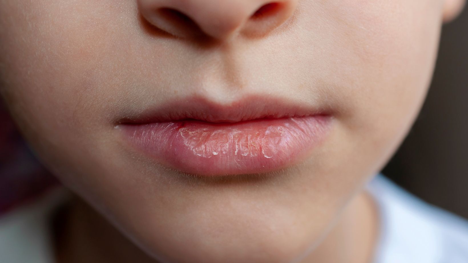 how-to-get-rid-of-red-ring-around-lips-overnight-quick-and-effective